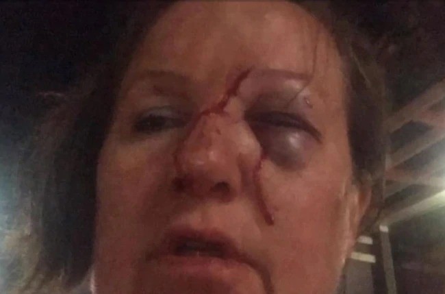 Brenda bị thương ở mặt sau khi quay video và bị tấn công. Ảnh: 7News.