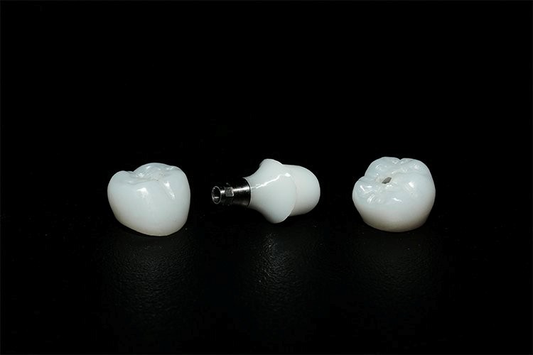 Đâu là điều cần quan tâm nhất khi trồng răng implant?- Ảnh 2.