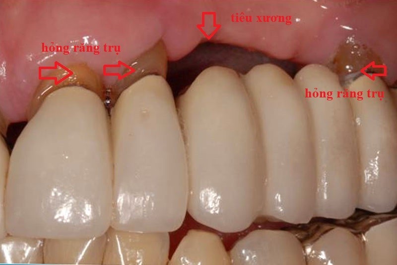 Mất răng, nên làm cầu hay cấy ghép nha khoa?- Ảnh 2.