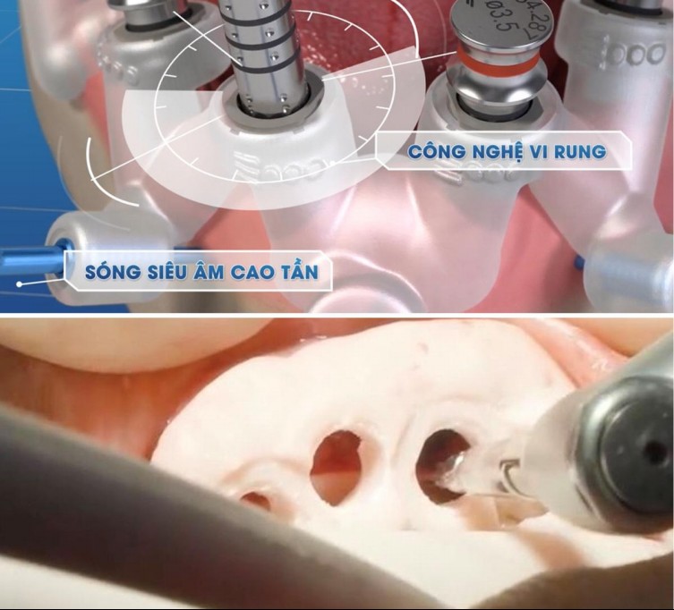 Trồng răng implant DCT - Giải pháp ăn nhai bền vững cho người mất răng- Ảnh 1.